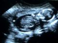 Sonogram Pregnancy 15 weeks - Embarazo 15 semanas