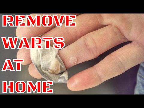 how to remove warts