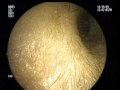 Right Middle Ear Effusion (Fluid Behind the Ear Drum)