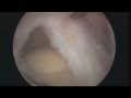 I uploaded a YouTube video -- Uk Surgeon - www.shouldersurgery.org.uk - Rotator Cuff Re... http://youtu.be/LuIo-K89Pto?a