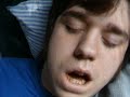 wisdom-teeth-gone-bad.html