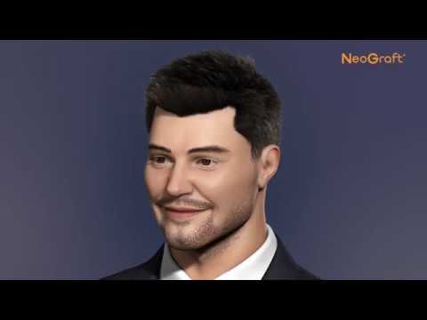 How NeoGraft works
