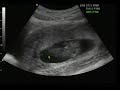 3D Ultrasound Baby 3D Ultrasound Baby
