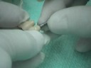Large Maxillary Molars Implant and Restorations Part 4