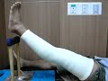 PCL injury Quadriceps exercise ??????????????