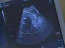 NJN News Healthwatch Report - Hysterectomy Alternative