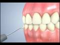 videos de Dental Pick & Scaler