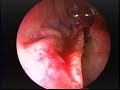 Endoscopic Nasal Septoplasty Endoscopic Nasal Septoplasty