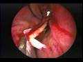 Endoscopic Nasal Septoplasty