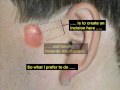 Preauricular Ear Sinus Infection