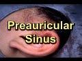 Preauricular Ear Sinus Infection