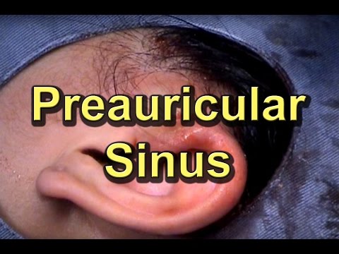 how to drain preauricular pit
