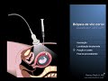 Dr. Hermes Prado Jr, autor do website http://www.artesmedicas.com, narra com animação digital de sua autoria este importante procedimento médico onde amostra do componente da placenta chamado de vilo corial é retirada com seringa e agulha para posterior análise laboratorial. Todo o procedimento é orientado pela visão das imagens ultra-sonográficas em monitor acompanhado pelo médico que realiza o procedimento com o intuito de localizar com precisão a estrutura-alvo e, sobretudo, ampliar a segurança do procedimento, evitando-se lesão de órgãos adjacentes ou do próprio feto.