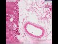 Histopathology Pancreas --Type 2 Diabetes mellitus