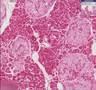 Histopathology Pancreas --Type 2 Diabetes mellitus