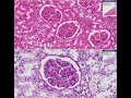 Histopathology Kidney--Membranous glomerulonephritis