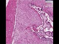 Histopathology Placenta--Implantation site