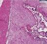 Histopathology Placenta--Implantation site