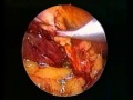 Laparoscopic Cholecystectomy with LAVH