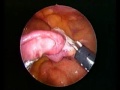 Laparoscopic Cholecystectomy with LAVH Laparoscopic Cholecystectomy with LAVH