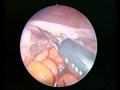 Laparoscopic Cholecystectomy with LAVH