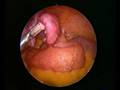 Laparoscopic Cholecystectomy with LAVH