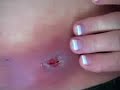 The aftermath of a black widow