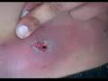 The aftermath of a black widow