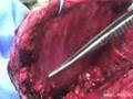 Prosthesis Of Scapula Radical Removal Due To Sarcoma Of The Ewing - Part 3