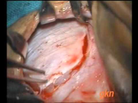 how to harvest fascia lata graft