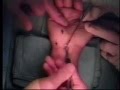 Endoscopic Carpal Tunnel Release Surgery