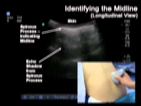 how to locate lumbar puncture site