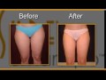 SmartLipo - Smartlipo.com