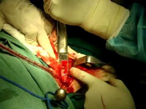 how to harvest iliac bone graft