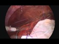 Incisional Hernia Laparoscopic Repair 