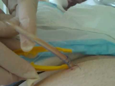 how to remove jp drain