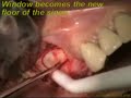 Nobel Biocare Implant Treatment