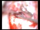 MRM cholesteatoma  EAC Fistula sai 271108
