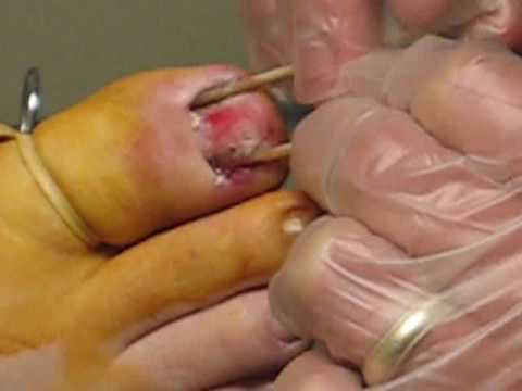 toenail