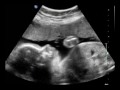baby waves video 3d sonogram