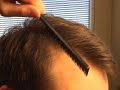 Hair transplant closeup: hairline central density