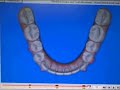 Clincheck For Invisalign Clincheck For Invisalign