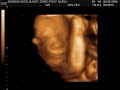 Mini Noe 25 semanas Mini Noe 25 semanas