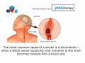 Spot a Stroke! Spot a Stroke!