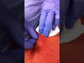 Lancing mrsa