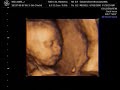 4D Ultrasound of Baby Hailie (24 weeks) 4D Ultrasound of Baby Hailie (24 weeks)