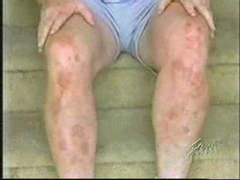 how to treat a yellow jacket sting