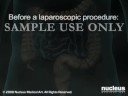 3D MEDICAL ANIMATION- Laparoscopic Appendectomy Surgery (App