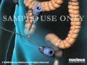 3D MEDICAL ANIMATION- Laparoscopic Appendectomy Surgery (App