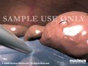 3D MEDICAL ANIMATION- Laparoscopic Appendectomy Surgery (App